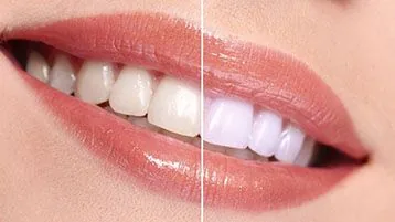 Comparación visual de tono dental para blanqueamiento
