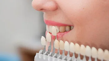 Carillas dentales para mejorar forma y color de la sonrisa