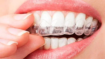 Guarda dental personalizada para proteger los dientes