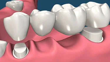 Coronas y puente dental para rehabilitación oral
