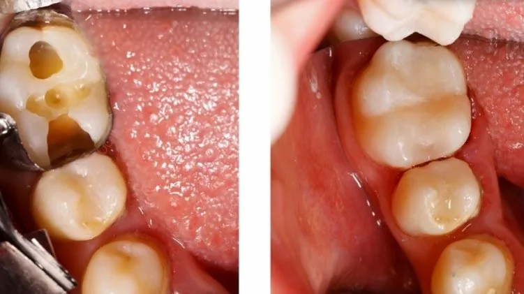 Restauración dental con resina del color del diente